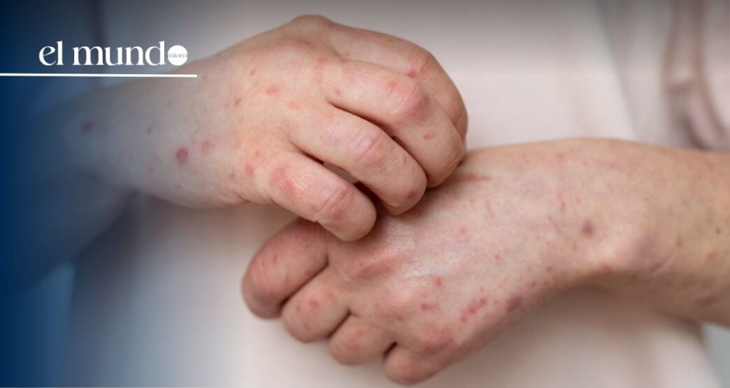 Measles in Florida: Cases Increase in 2026 While Delays in Official Data Persist