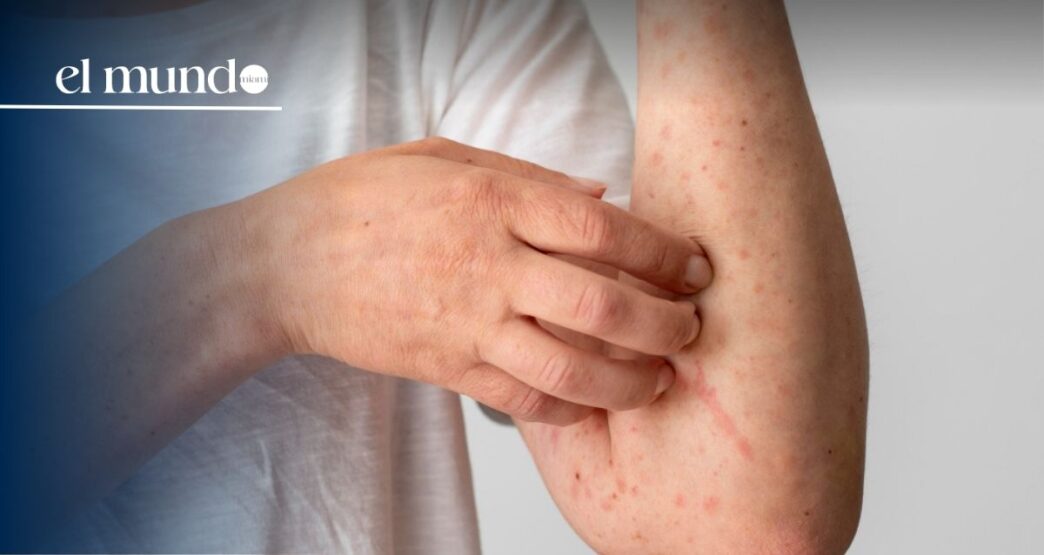 Florida among the states with the most measles cases in the United States