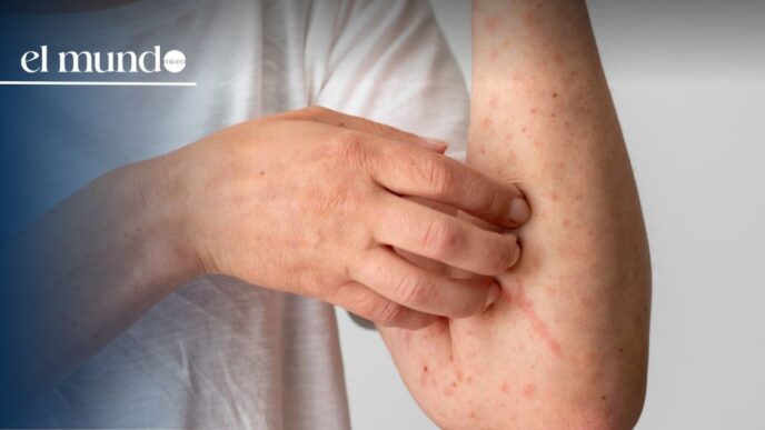 Florida among the states with the most measles cases in the United States